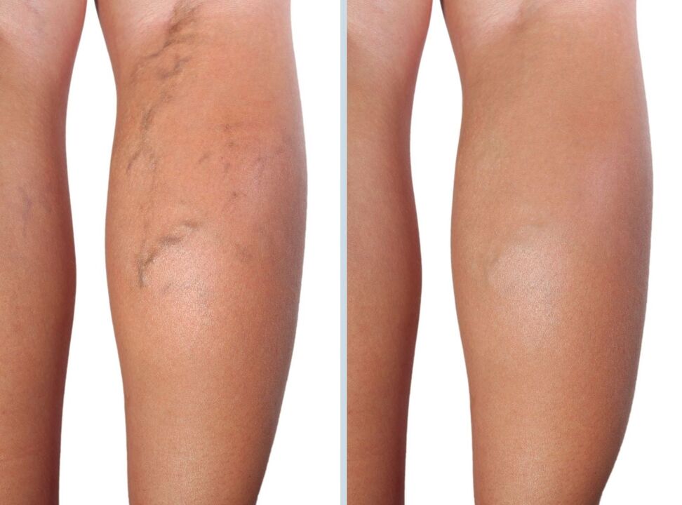My experience in the application of a neuveris gel
