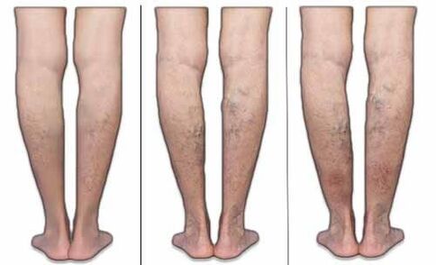 Varicose vein stages
