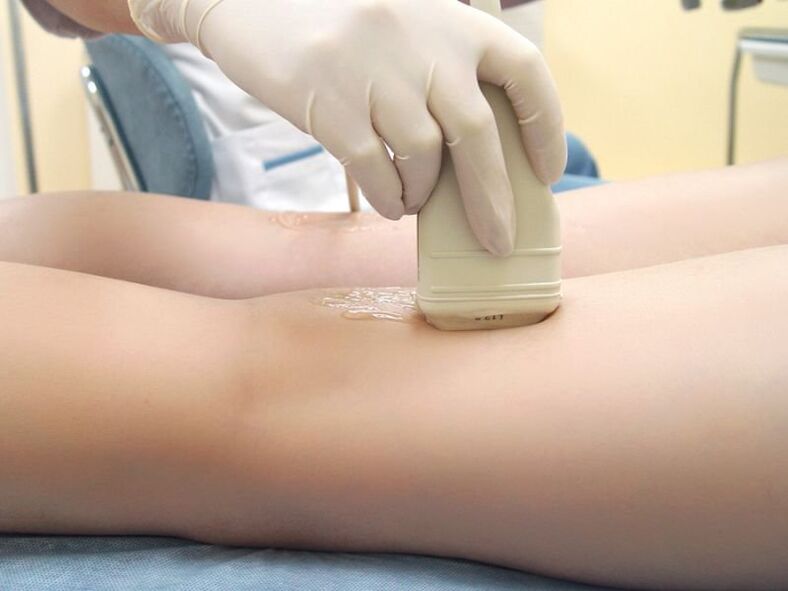 Treatment of varicose veins