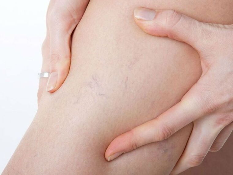 Varicose veins on their feet