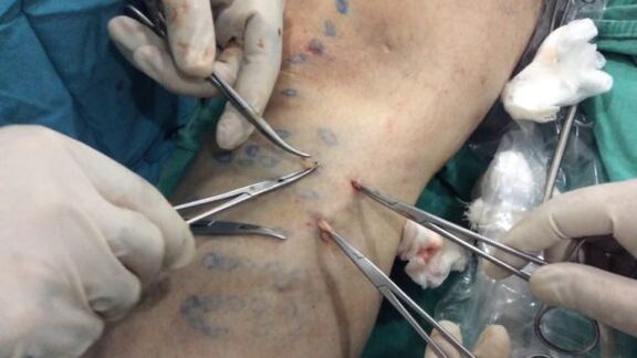 surgery