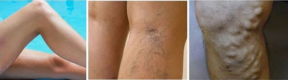 The appearance of varicose veins on their feet