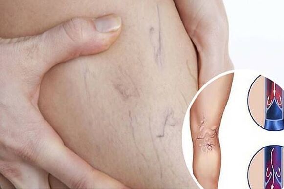 Photo of varicose veins