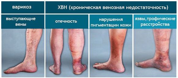 Varicose vein stages