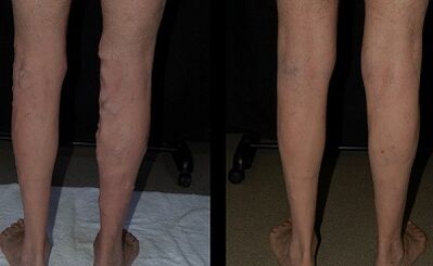 Treatment of varicose veins with laser Photo before and after
