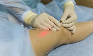 Treatment of varicose veins with laser