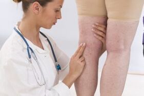 The Flekbologist examines the patient with varicose veins