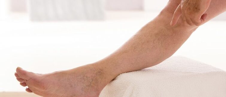 Varicose veins on their feet