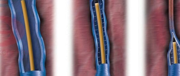 The essence of radiofrequency obliteration in the treatment of varicose veins